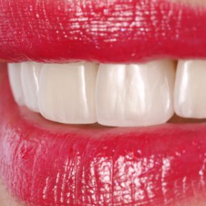 Veneers