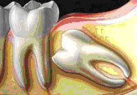 Сложное удаление зуба мудрости с использованием ультразвука