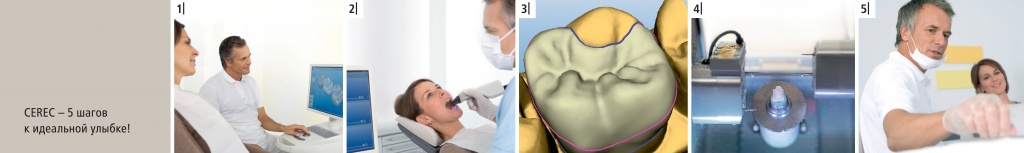 лечение кариеса и разрушенных зубов с Cerec Omnicam